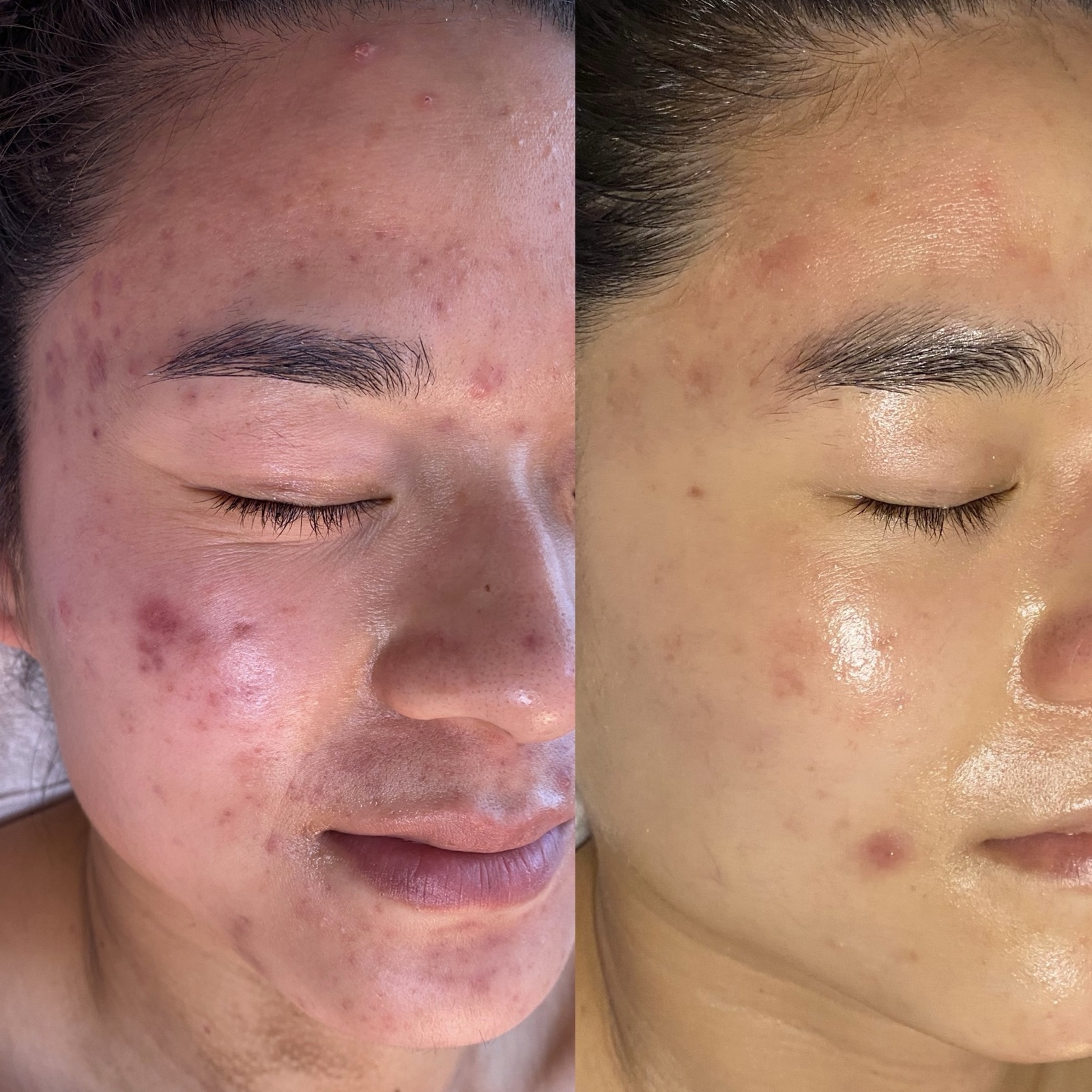 Side-by-side comparison of a person's face showing improvement in skin condition, with acne and blemishes reduced on the right.