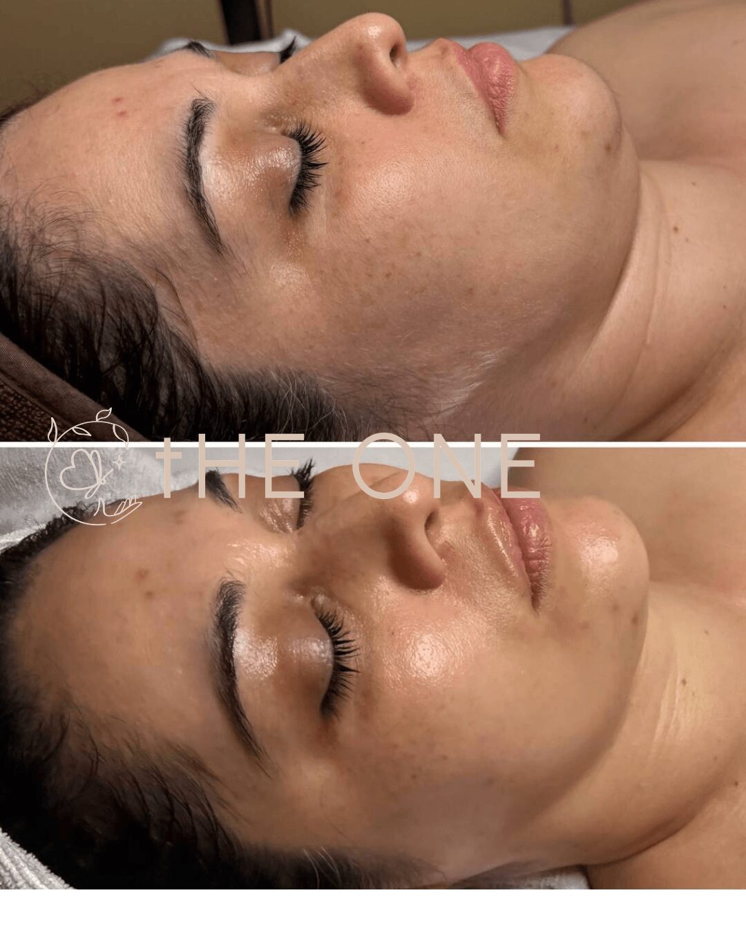 Side view of a woman's face with eyes closed, showing before and after skin treatment, with smooth skin and clear complexion.