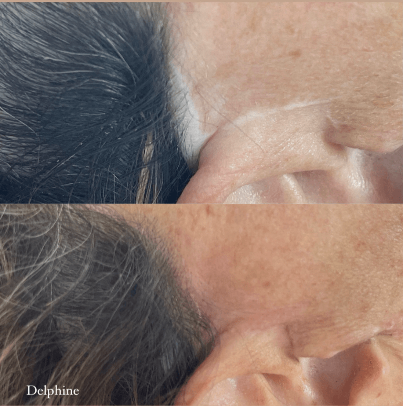 Close-up of a person's ear and hair, showing a comparison before and after a change, with visible skin and hair details.