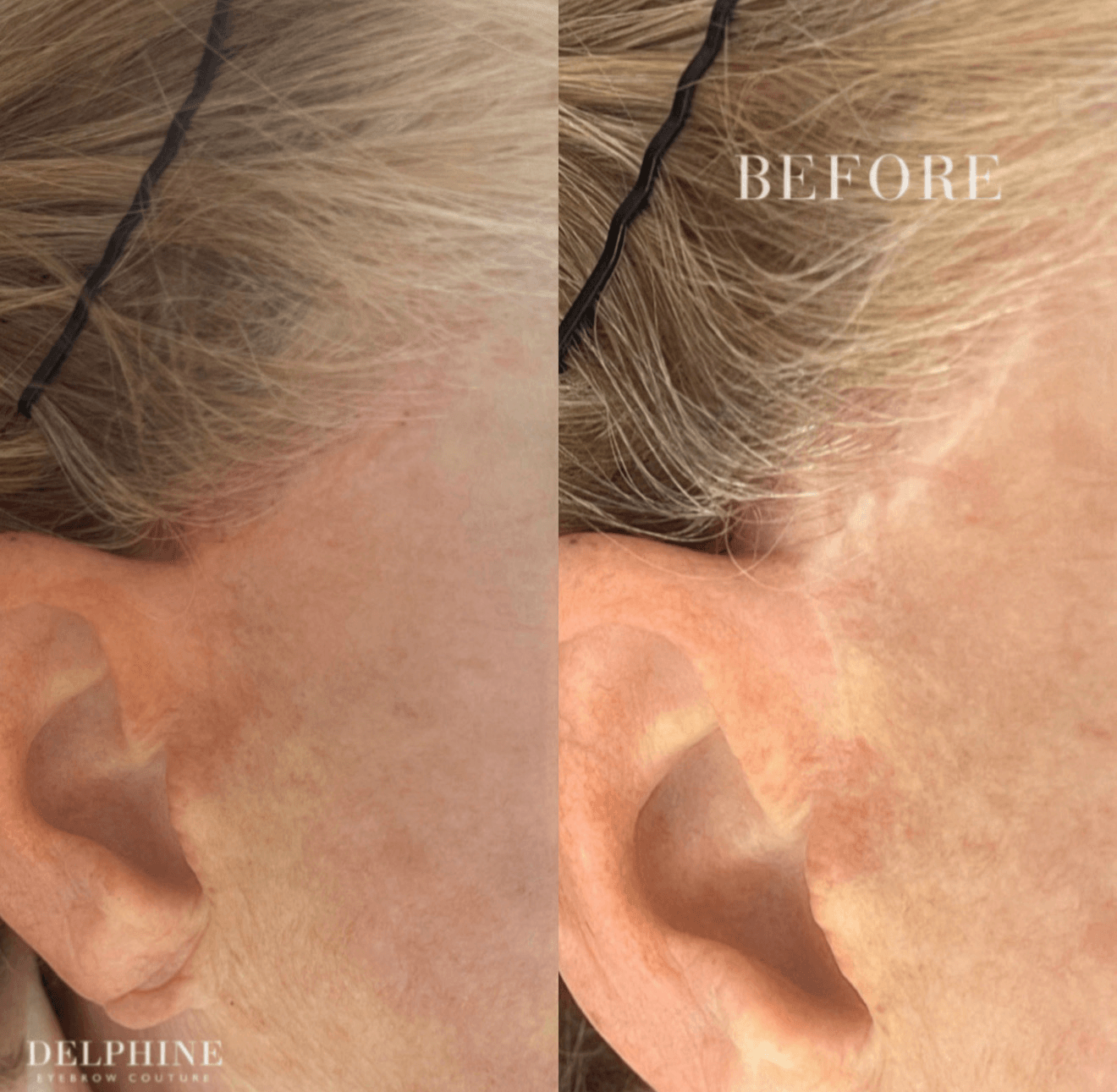 Side-by-side comparison of skin before and after treatment, showing improved skin texture and tone on the right side.