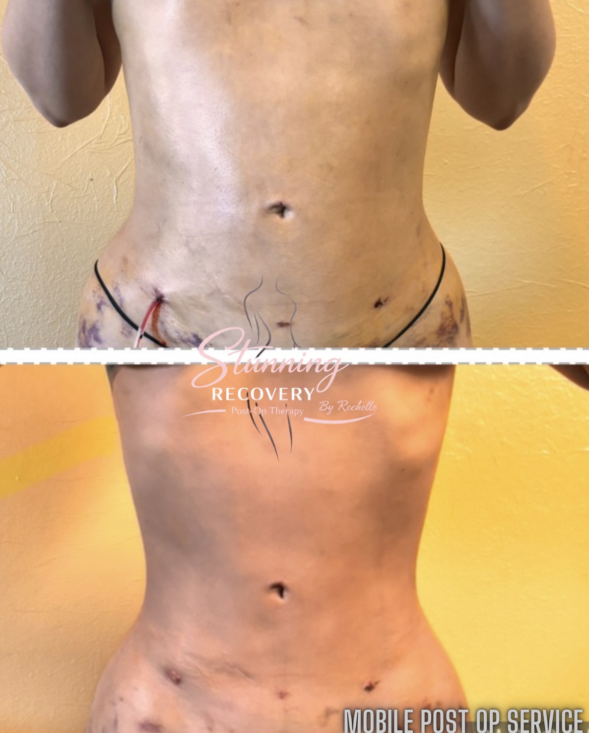 Before and after images of a person's abdomen showing surgical scars and healing progress.