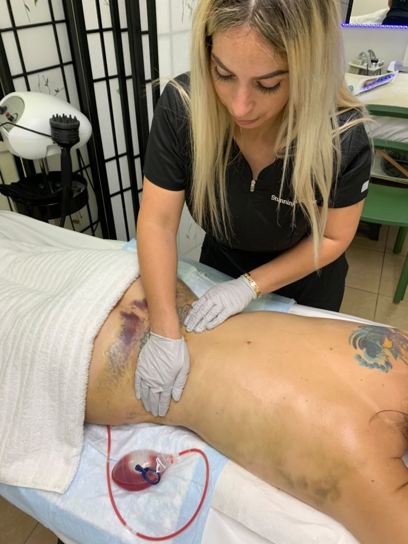Medical professional performing a procedure on a patient's abdomen in a clinical setting.
